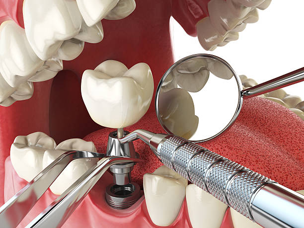Best Emergency Root Canal Treatment in Napoleon, OH